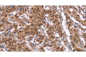 Immunohistochemistry of paraffin-embedded Human gasrtic cancer tissue using ID4 Polyclonal Antibody at dilution 1:40 (ID4 antibody)