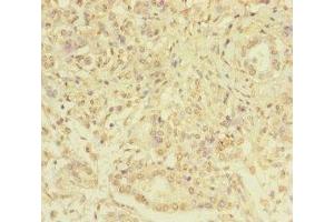 Immunohistochemistry of paraffin-embedded human pancreatic cancer using ABIN7169347 at dilution of 1:100 (SERPINB6 antibody  (AA 180-300))