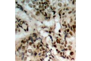 Immunohistochemical analysis of PTEN (pS380/T382/T383) staining in human prostate cancer formalin fixed paraffin embedded tissue section.