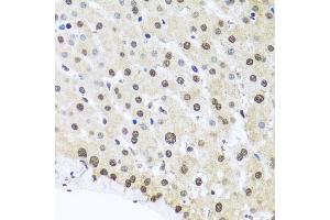 Immunohistochemistry of paraffin-embedded human liver injury using FUBP1 antibody. (FUBP1 antibody)