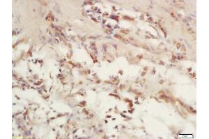Formalin-fixed and paraffin embedded human laryngeal carcinoma labeled with Rabbit Anti-COX6c/Cytochrome C Oxidase subunit VIc Polyclonal Antibody, Unconjugated (ABIN1714715) at 1:200 followed by conjugation to the secondary antibody and DAB staining