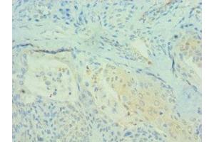 Immunohistochemistry of paraffin-embedded human breast cancer using ABIN7164694 at dilution of 1:100 (PDCD4 antibody  (AA 1-260))