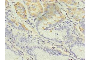 Immunohistochemistry of paraffin-embedded human gastric cancer using ABIN7148027 at dilution of 1:100 (CBLIF (AA 19-417) antibody)