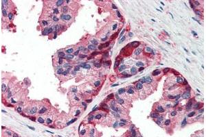 Human Prostate (formalin-fixed, paraffin-embedded) stained with GSTP1 antibody ABIN337104 at 5 ug/ml followed by biotinylated anti-goat IgG secondary antibody ABIN481715, alkaline phosphatase-streptavidin and chromogen. (GSTP1 antibody  (AA 22-33))