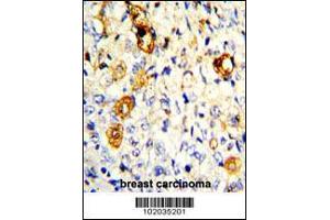 Formalin-fixed and paraffin-embedded human breast carcinoma with MMP19 Antibody , which was peroxidase-conjugated to the secondary antibody, followed by DAB staining.