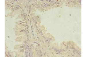 Immunohistochemistry of paraffin-embedded human prostate cancer using ABIN7165657 at dilution of 1:100 (ITPRID2 (AA 1-267) antibody)