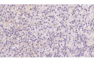 ABIN6273093 at 1/100 staining Human lymph cancer tissue by IHC-P. (BBS7 antibody  (Internal Region))