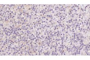 ABIN6273093 at 1/100 staining Human lymph cancer tissue by IHC-P.