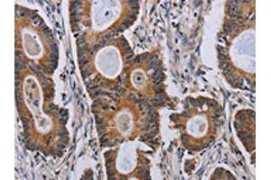 The image on the left is immunohistochemistry of paraffin-embedded Human colon cancer tissue using ABIN7191791(PARP8 Antibody) at dilution 1/40, on the right is treated with synthetic peptide. (PARP8 antibody)