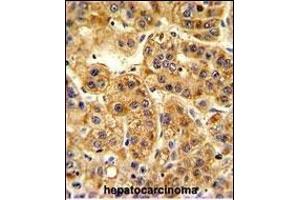 Formalin-fixed and paraffin-embedded human hepatocarcinoma reacted with SIL1 Antibody (Center), which was peroxidase-conjugated to the secondary antibody, followed by DAB staining. (SIL1 antibody  (AA 99-126))