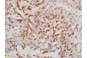 Formalin-fixed and paraffin embedded human lung carcinoma labeled with Rabbit Anti-BTK (Tyr223) Polyclonal Antibody, Unconjugated  at 1:200 followed by conjugation to the secondary antibody and DAB staining (BTK antibody  (pTyr223))