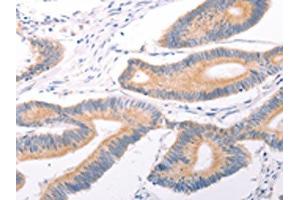 The image on the left is immunohistochemistry of paraffin-embedded Human colon cancer tissue using ABIN7131495(TRPC7 Antibody) at dilution 1/25, on the right is treated with fusion protein. (TRPC7 antibody)