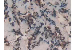 DAB staining on IHC-P; Samples: Human Breast cancer Tissue (TAF12 antibody  (AA 1-161))
