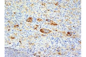 Formalin-fixed, paraffin-embedded human Erdheim-Chester disease (also known as polyostotic sclerosing histiocytosis) stained with TNF alpha Mouse Monoclonal Antibody (TNFA/1172). (TNF alpha antibody)