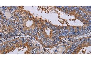 Immunohistochemistry of paraffin-embedded Human colon cancer using LIMS1 Polyclonal Antibody at dilution of 1:40 (LIMS1 antibody)