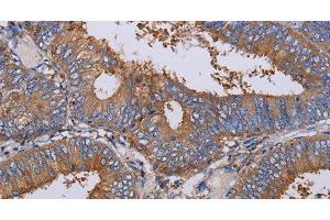 Immunohistochemistry of paraffin-embedded Human colon cancer using LIMS1 Polyclonal Antibody at dilution of 1:40