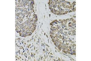 Immunohistochemistry of paraffin-embedded human esophageal cancer using CD62P/P-selectin antibody (ABIN6131514, ABIN6147503, ABIN6147506 and ABIN6218519) at dilution of 1:100 (40x lens).