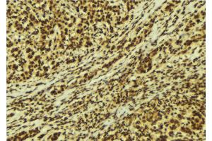 ABIN6269328 at 1/100 staining Human breast cancer tissue by IHC-P. (PKC delta antibody  (C-Term))