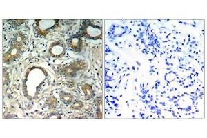 Immunohistochemical analysis of paraffin-embedded human breast carcinoma tissue, using SHP-2 (Phospho-Tyr580) antibody (E011320). (PTPN11 antibody  (pTyr580))