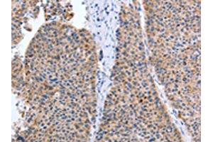 The image on the left is immunohistochemistry of paraffin-embedded Human liver cancer tissue using ABIN7131299(TAT Antibody) at dilution 1/35, on the right is treated with fusion protein. (Tat antibody)