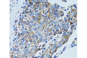 Immunohistochemistry of paraffin-embedded Human lung cancer using MRPL28 Polyclonal Antibody at dilution of 1:100 (40x lens). (MRPL28 antibody)
