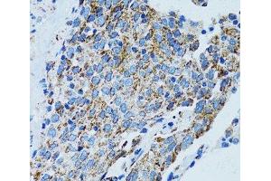 Immunohistochemistry of paraffin-embedded Human lung cancer using MRPL28 Polyclonal Antibody at dilution of 1:100 (40x lens).