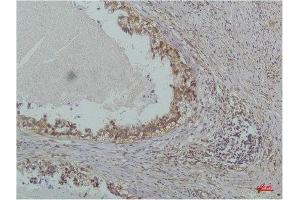 Immunohistochemistry (IHC) analysis of paraffin-embedded Human Lung Carcinoma using IkappaB beta(Mouse Monoclonal Antibody diluted at 1:200. (NFKBIB antibody)