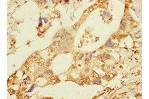 Immunohistochemistry of paraffin-embedded human pancreatic cancer using ABIN7165454 at dilution of 1:100 (FAM187B antibody  (AA 18-335))