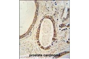 TME antibody (N-term) (ABIN654026 and ABIN2843945) immunohistochemistry analysis in formalin fixed and paraffin embedded human prostate carcinoma followed by peroxidase conjugation of the secondary antibody and DAB staining. (TMEM214 antibody  (N-Term))