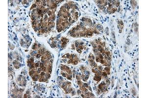 Immunohistochemical staining of paraffin-embedded Carcinoma of liver tissue using anti-DCXRmouse monoclonal antibody. (DCXR antibody)