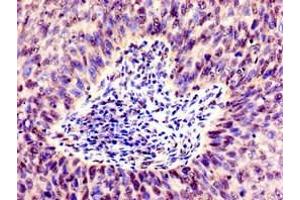 Immunohistochemistry of paraffin-embedded human cervical cancer using ABIN7171071 at dilution of 1:100 (SMARCD1 antibody  (AA 7-124))