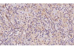 ABIN6273079 at 1/100 staining Human lymph cancer tissue by IHC-P. (SYVN1 antibody  (Internal Region))
