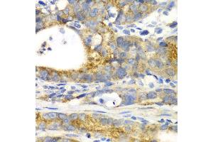 Immunohistochemistry of paraffin-embedded human gastric cancer using GORASP1 antibody at dilution of 1:100 (x40 lens). (GORASP1 antibody)