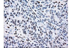 Immunohistochemical staining of paraffin-embedded Adenocarcinoma of breast tissue using anti-MAP2K2 mouse monoclonal antibody. (MEK2 antibody)