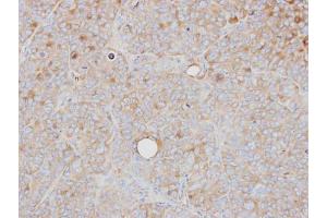IHC-P Image Immunohistochemical analysis of paraffin-embedded SW480 xenograft, using PRPS1, antibody at 1:500 dilution. (PRPS1 antibody)
