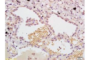 Formalin-fixed and paraffin embedded human lung carcinoma labeled with Anti- MASP Polyclonal Antibody, Unconjugated (ABIN733508) at 1:200, followed by conjugation to the secondary antibody and DAB staining. (MASP1 antibody  (AA 20-120))