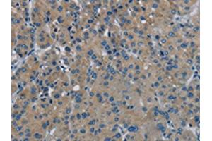 The image on the left is immunohistochemistry of paraffin-embedded Human liver cancer tissue using ABIN7191867(PHKG1 Antibody) at dilution 1/20, on the right is treated with synthetic peptide. (PHKG1 antibody)