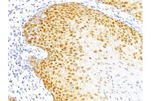 Formalin-fixed, paraffin-embedded human Cervical Cancer stained with p27 Monoclonal Antibody (DCS-72. (CDKN1B antibody)
