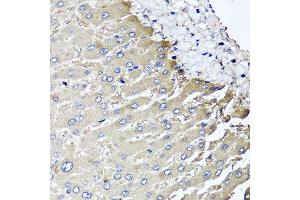 Immunohistochemistry of paraffin-embedded human liver injury using MGAT1 antibody at dilution of 1:100 (x40 lens). (MGAT1 antibody)