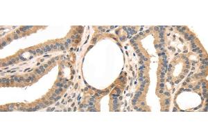 Immunohistochemistry of paraffin-embedded Human thyroid cancer tissue using TRIB3 Polyclonal Antibody at dilution 1:40 (TRIB3 antibody)