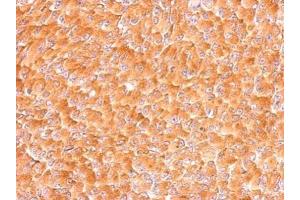 IHC-P Image AIMP1 antibody detects SCYE1 protein at cytosol on H1299 xenograft by immunohistochemical analysis. (AIMP1 antibody)