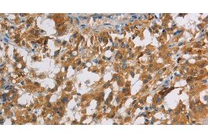 Immunohistochemistry of paraffin-embedded Human thyroid cancer using DBH Polyclonal Antibody at dilution of 1:70 (DBH antibody)