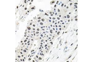 Immunohistochemistry of paraffin-embedded human lung cancer using CDC antibody (ABIN6127612, ABIN6138273, ABIN6138274 and ABIN6216282) at dilution of 1:100 (40x lens). (CDCA8 antibody  (AA 1-280))