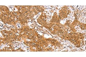 Immunohistochemistry of paraffin-embedded Human cervical cancer using RGS22 Polyclonal Antibody at dilution of 1:40