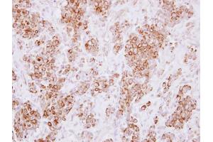 IHC-P Image Immunohistochemical analysis of paraffin-embedded human breast cancer, using HLA-DMA, antibody at 1:250 dilution. (HLA-DMA antibody)