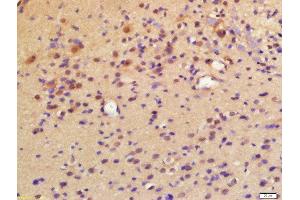 Formalin-fixed and paraffin embedded labeled with Rabbit Anti-LPCAT2 Polyclonal Antibody, Unconjugated (ABIN2177389) at 1:200 followed by conjugation to the secondary antibody and DAB staining (LPCAT2 antibody  (AA 131-230))
