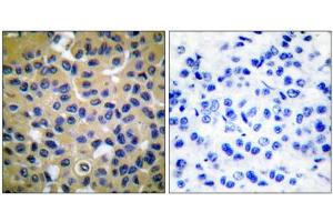 Immunohistochemical analysis of paraffin-embedded human breast carcinoma tissue, using COL2 antibody (ABIN5976364). (COL2 antibody  (N-Term))