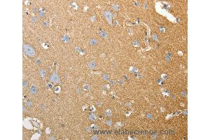 Immunohistochemistry of Human colon cancer using SLC4A4 Polyclonal Antibody at dilution of 1:50 (SLC4A4 antibody)