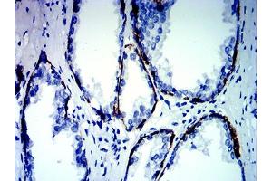 Immunohistochemical analysis of paraffin-embedded prostate cancer tissues using KRT13 mouse mAb with DAB staining. (Cytokeratin 13 antibody  (AA 104-458))
