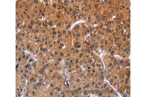 Immunohistochemistry of Human liver cancer using ING2 Polyclonal Antibody at dilution of 1:40 (ING2 antibody)